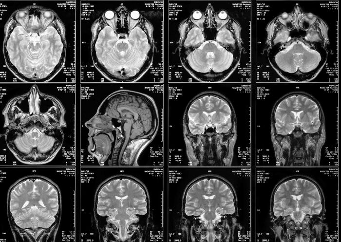 MR-scan  av hode. Illustrasjon: Colourbox