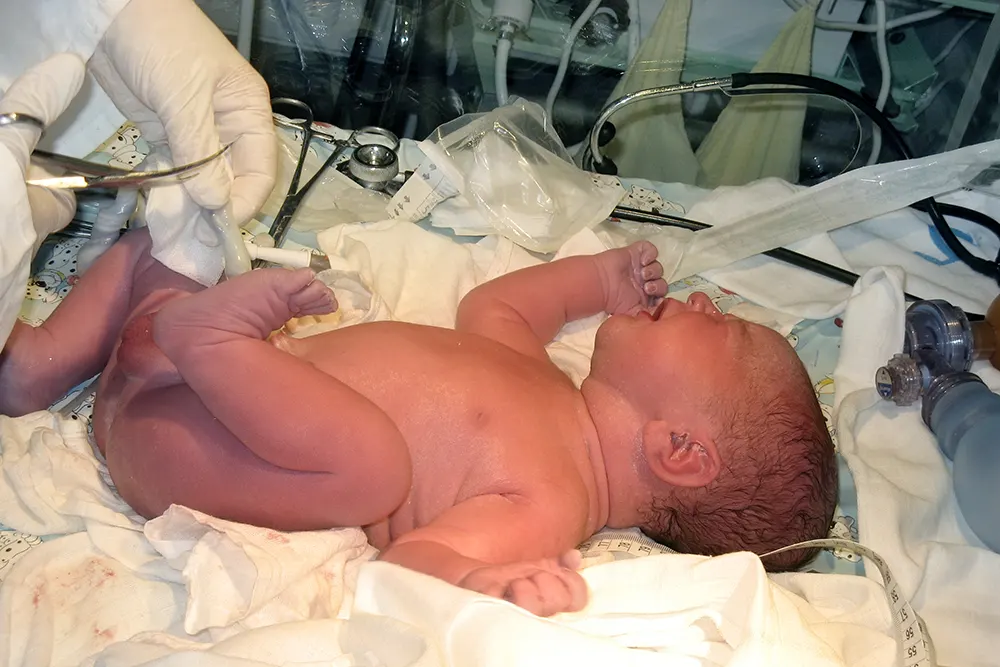 Nyfødd baby som får navlestrengen klipt av