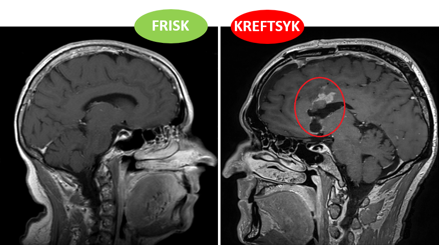 Kreft